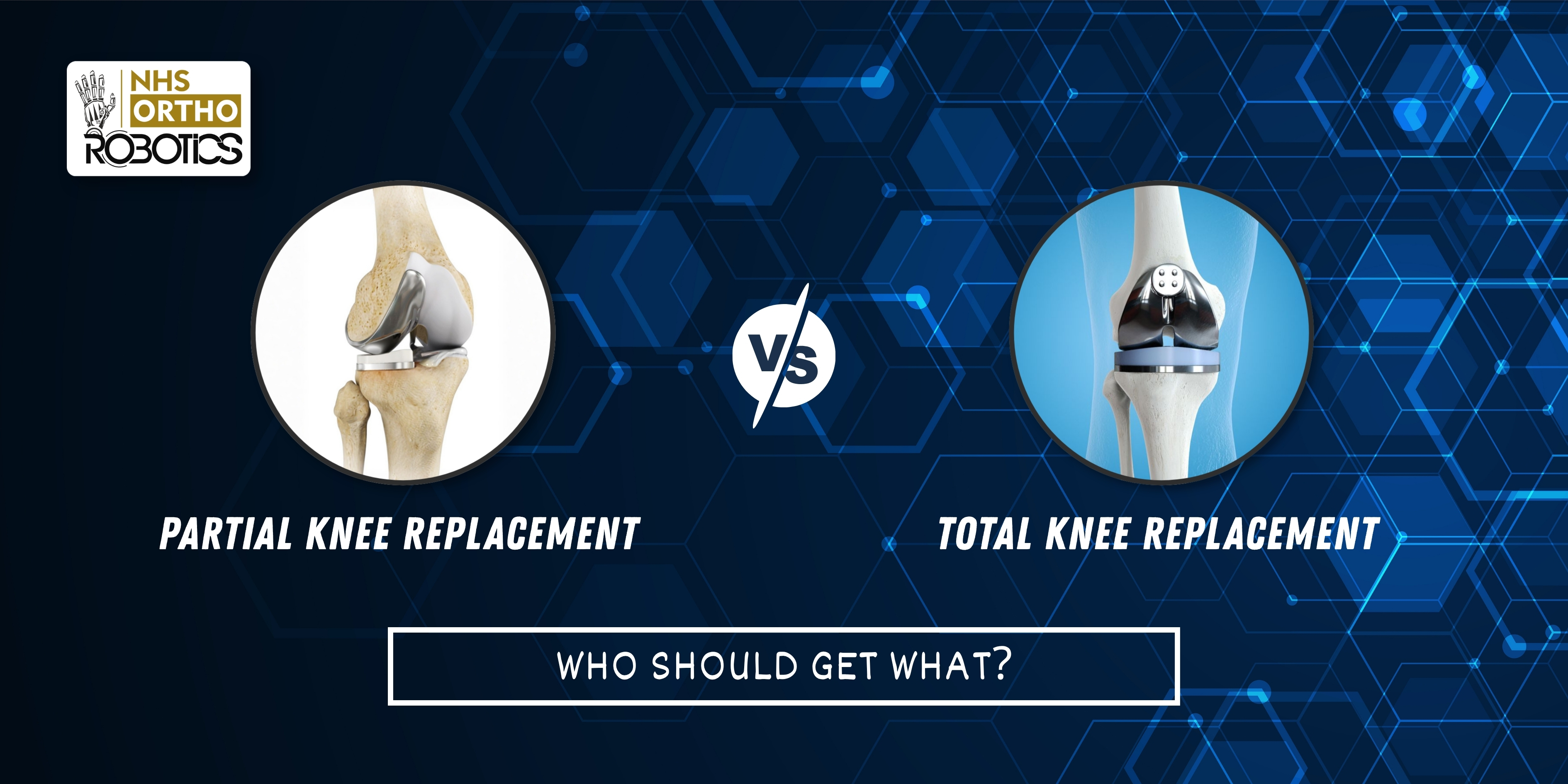 Partial vs Total Knee Replacement – Who Should Get What